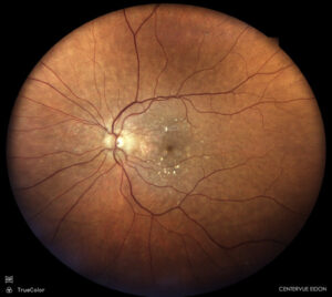 Macular healthin sight for May