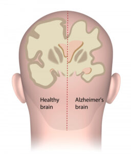 Gum disease Alzheimers link