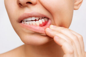 Heart disease linked to poor oral health