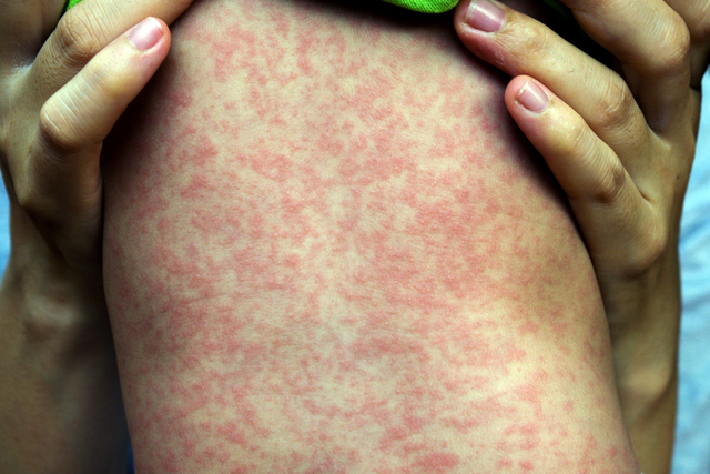 Vax rollout with measles on the rise