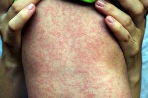 Measles cases rise as health officials warn of vaccination gaps